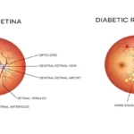 Diabetic Retinopathy