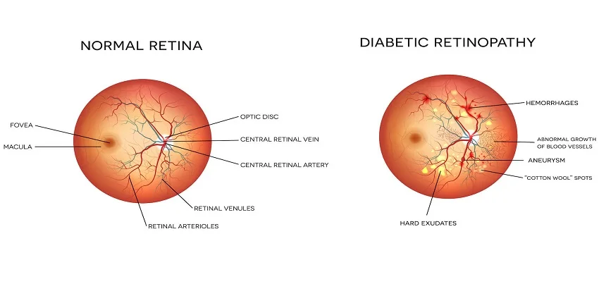 Diabetic Retinopathy
