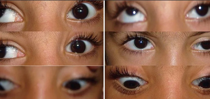 Double Elevator Palsy