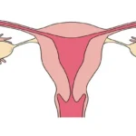 Ectopic pregnancy