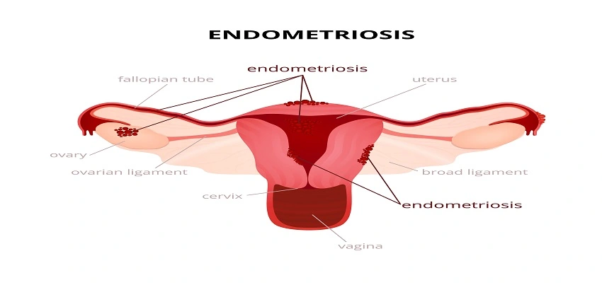 Endometriosis