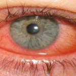 Epidemic Keratoconjunctivitis (EKC)