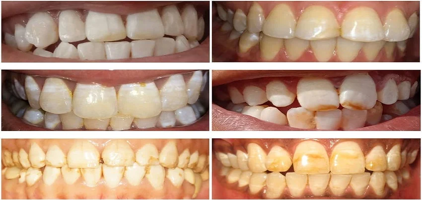 Fluorosis