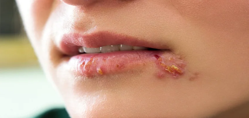 Herpes simplex