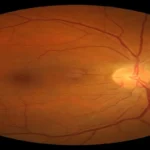 Hypertensive Retinopathy