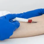 Lactate Dehydrogenase (LDH) Test