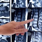 MRI-of-the-Lumbar-and-Sacral-Spine