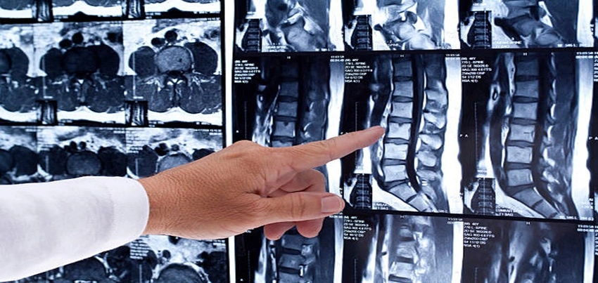 MRI-of-the-Lumbar-and-Sacral-Spine