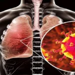 Middle East respiratory syndrome coronavirus (MERS-CoV)