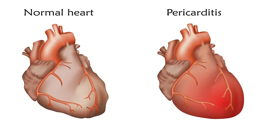 Pericarditis