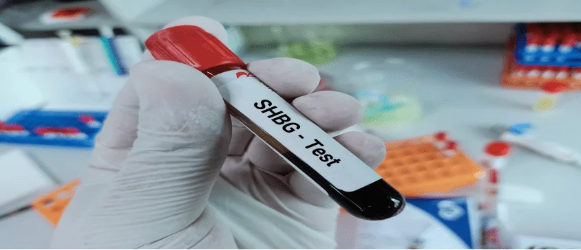 Sex hormone binding globulin (SHBG) Test