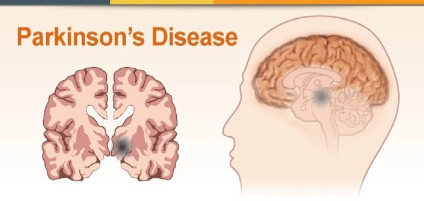 Parkinson's disease (PD)