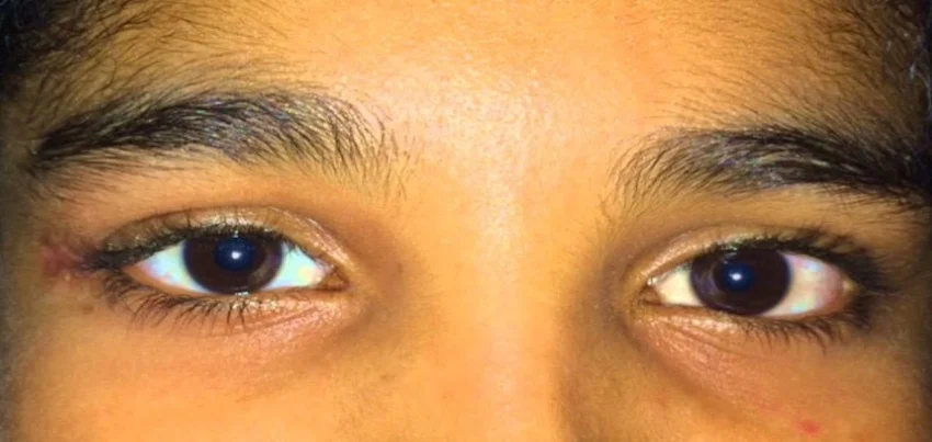 Acquired capillary haemangioma of the eyelid