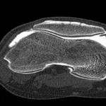 CT scan spiral joint / CT arthrogram