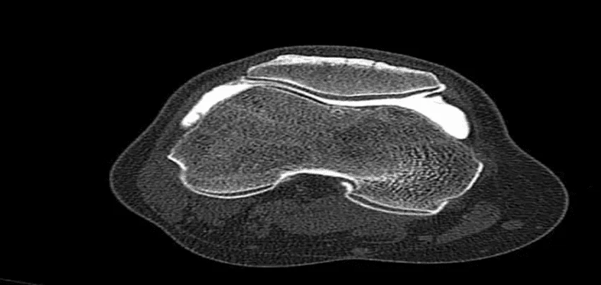 CT scan spiral joint / CT arthrogram