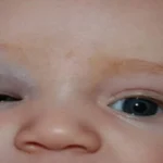 Congenital Capillary Haemangioma Of The Eyelid