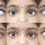 Duane Retraction Syndrome (DRS)