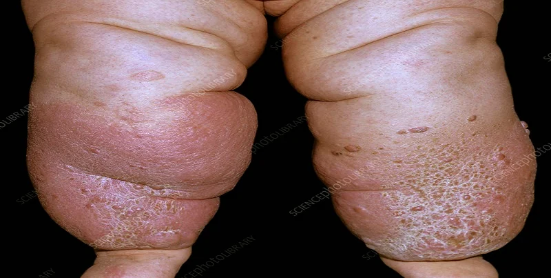 Lymphoedema