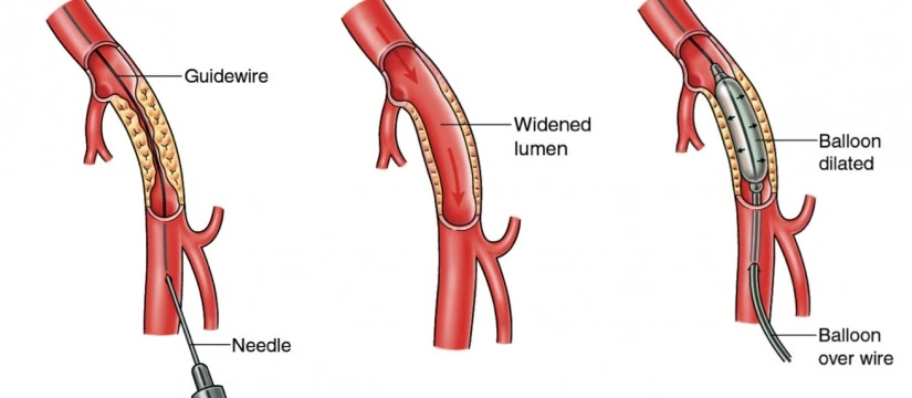 Angio Pulmonary