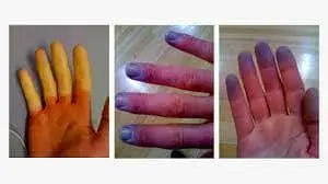 Raynaud's phenomenon1