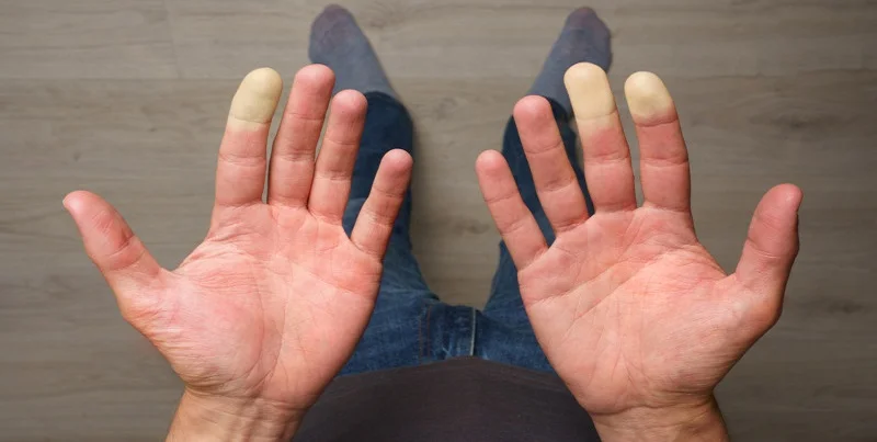 Raynaud's phenomenon
