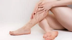 Varicose veins