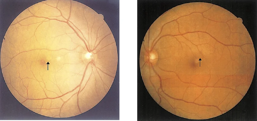 Welding-arc Maculopathy