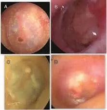 otitis media