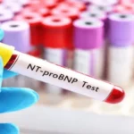 Pro B-type natriuretic peptide (proBNP) Test