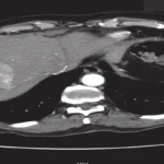 CT-Scan-of-the-Abdomen-Triphasic-Liver