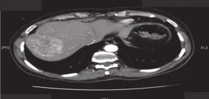 CT-Scan-of-the-Abdomen-Triphasic-Liver