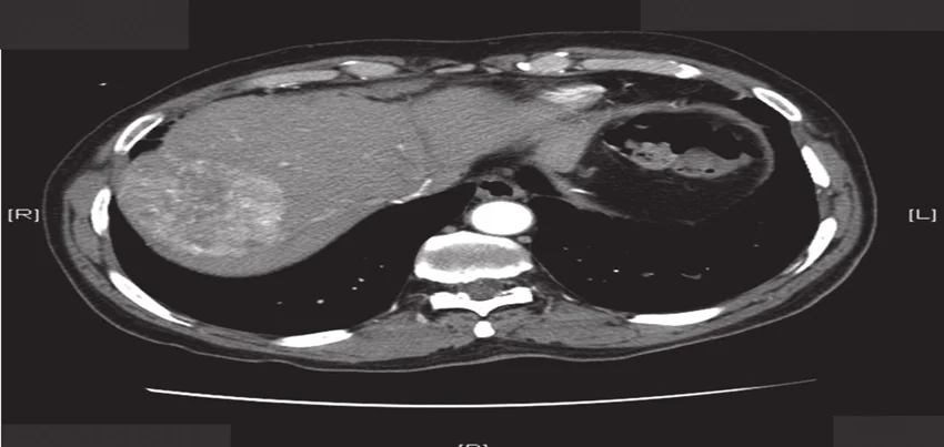 CT-Scan-of-the-Abdomen-Triphasic-Liver