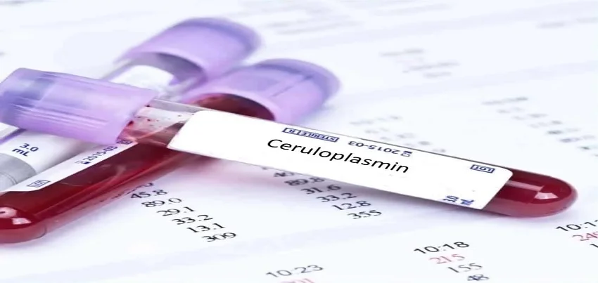Ceruloplasmin Test
