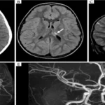 MRI Brain + Angiography