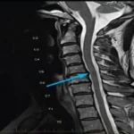 MRI Cervical Spine