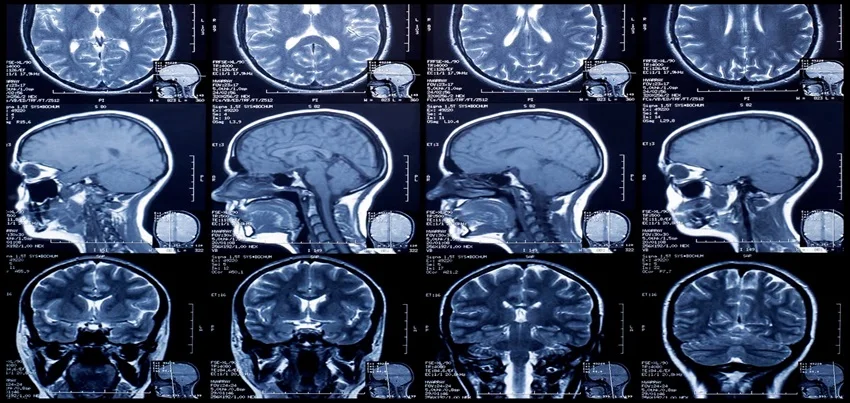 MRI Brain Screening