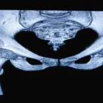 MRI of the Pelvis