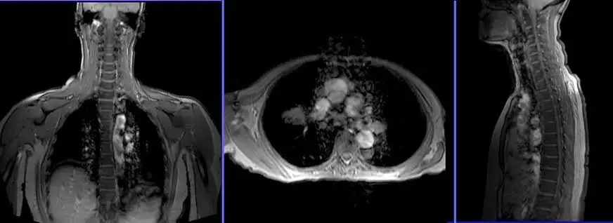 MRI of the thoracic spine