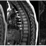MRI of the thoracic spine