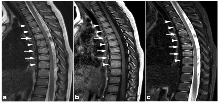 MRI of the thoracic spine