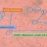 Sputum AFB (Acid-fast bacilli) Test
