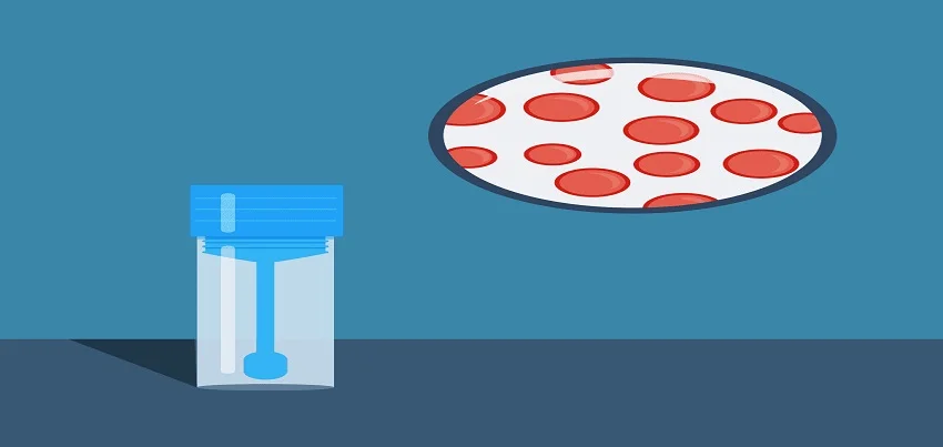 Stool occult blood Test