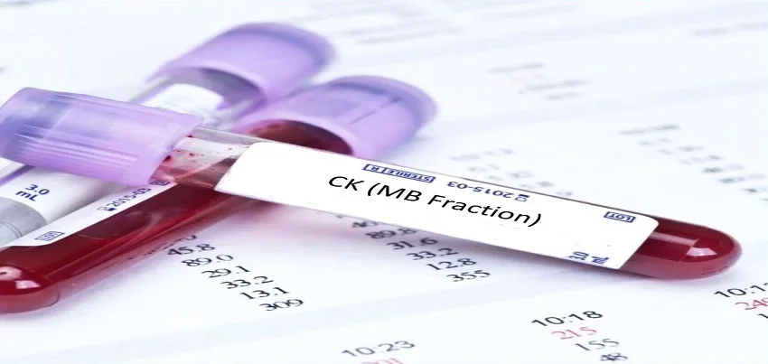 Creatinine Kinase-MB (CK-MB) Test