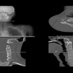 CT scan of the neck