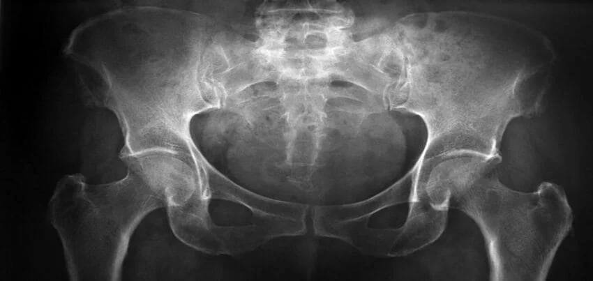 CT scan for the pelvis