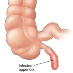 Appendicitis: Types, Symptoms, Prevention and Treatment