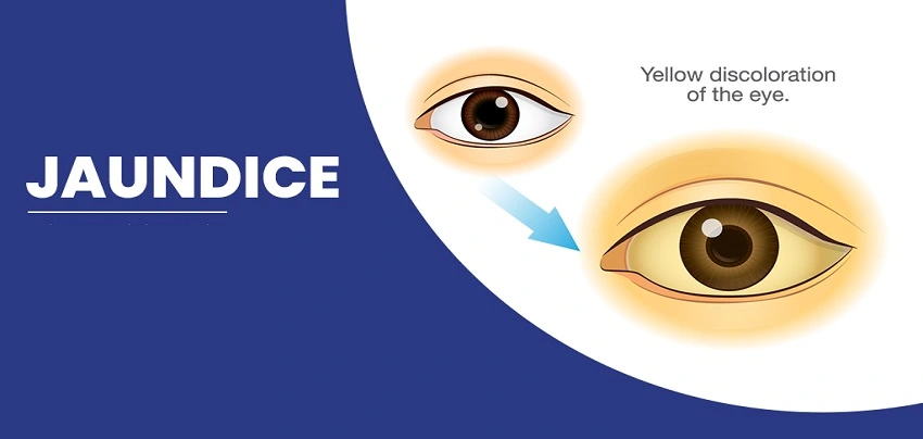 JAUNDICE_