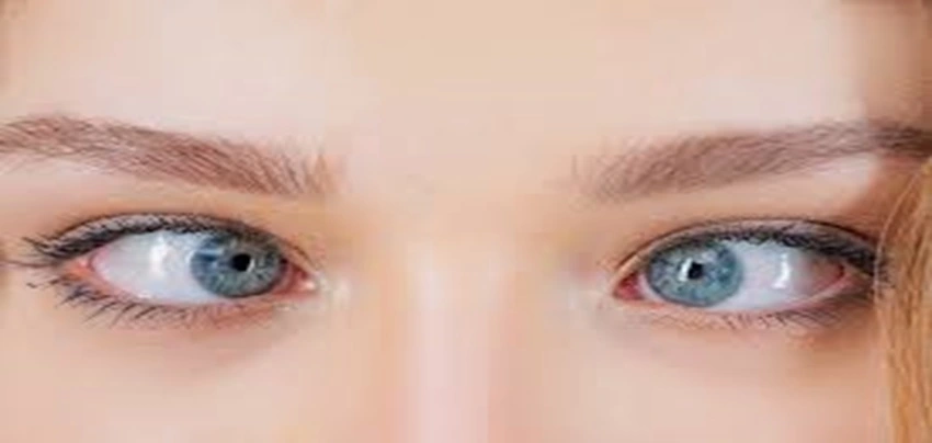 Strabismus