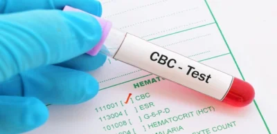 CBC-Test-in-Udaipur