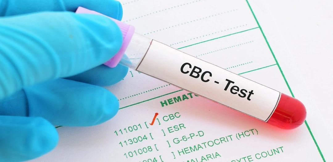 CBC-Test-in-Udaipur